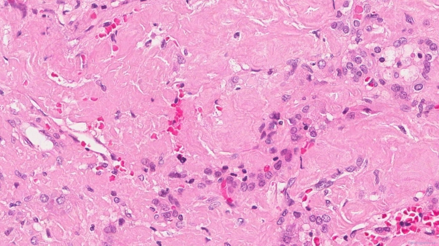 Amyloidoma of the thyroid gland