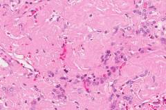 Amyloidoma of the thyroid gland