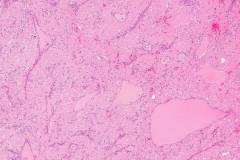 Amyloidoma of the thyroid gland