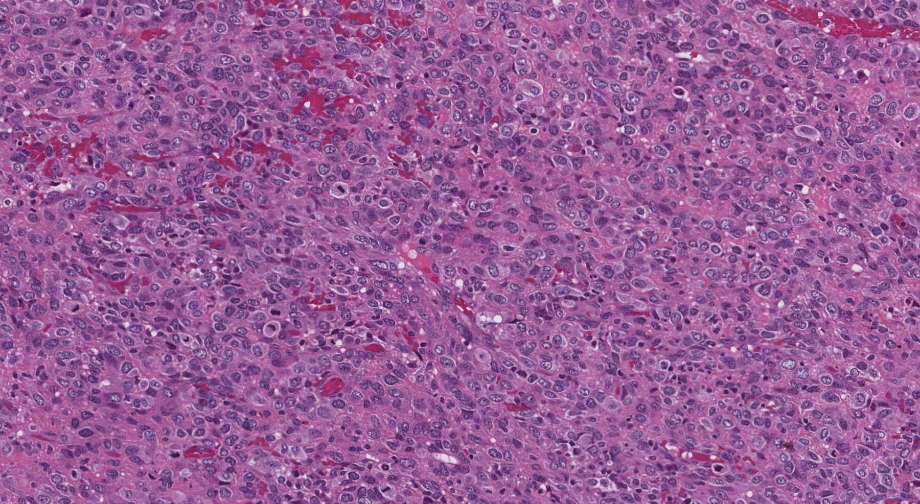 Anaplastic Thyroid Carcinoma Ottawa Atlas Of Pathology anaplastic-thyroid-carcinoma-ottawa-atlas-of-pathology