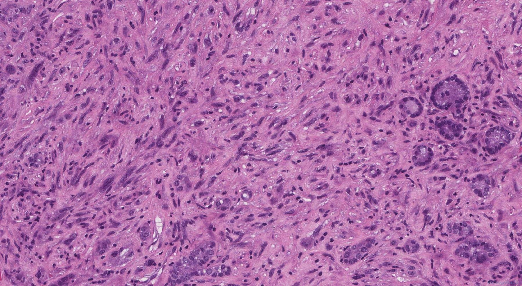 anaplastic thyroid carcinoma icd 10 code