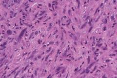 Anaplastic thyroid carcinoma