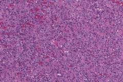 Anaplastic thyroid carcinoma