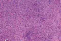 Anaplastic thyroid carcinoma