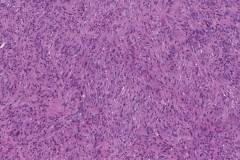 Anaplastic thyroid carcinoma