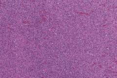 Anaplastic thyroid carcinoma