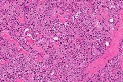 Anaplastic thyroid carcinoma