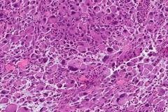 Anaplastic thyroid carcinoma