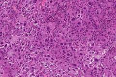 Anaplastic thyroid carcinoma