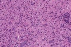Anaplastic thyroid carcinoma