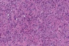 Anaplastic thyroid carcinoma
