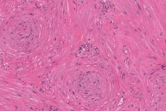 Angiomyoma