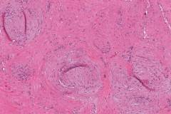 Angiomyoma
