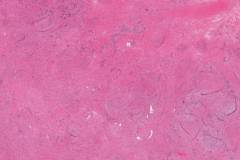 Angiomyoma