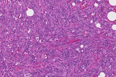 Radiation induced angiosarcoma of the breast