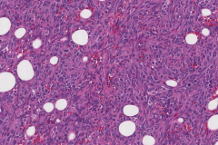 Radiation induced angiosarcoma of the breast