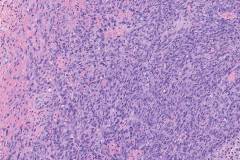 Angiosarcoma