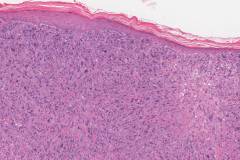 Atypical fibroxanthoma