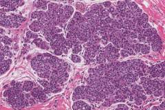 Atypical lobular hyperplasia in the breast