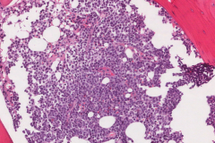 B lymphoblastic leukemia