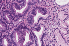 Barrett's esophagus with low grade dysplasia