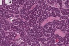 Basal cell adenoma of the parotid gland