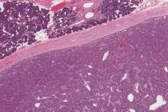Basal cell adenoma of the parotid gland