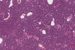 Basal cell adenoma of the parotid gland