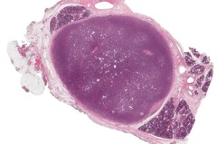 Basal cell adenoma of the parotid gland