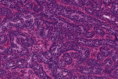 Basal cell adenoma