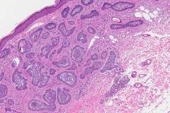Micronodular basal cell carcinoma of the skin