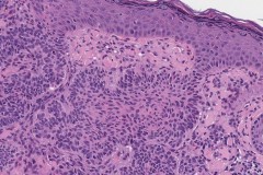 Basal cell carcinoma of the skin