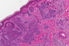 Basosquamous carcinoma of the skin