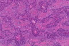 Basosquamous carcinoma of the skin