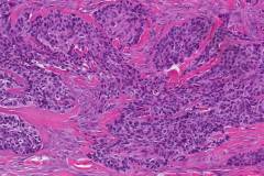 Basosquamous carcinoma of the skin