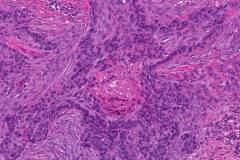 Basosquamous carcinoma of the skin