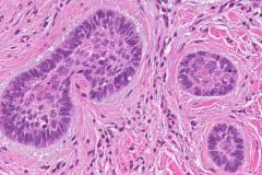 Micronodular basal cell carcinoma of the skin