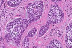 Micronodular basal cell carcinoma of the skin