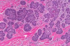 Micronodular basal cell carcinoma of the skin