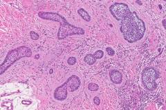 Micronodular basal cell carcinoma of the skin
