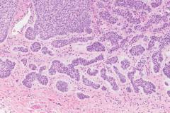 Micronodular basal cell carcinoma of the skin