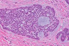 Micronodular basal cell carcinoma of the skin