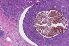 Basal cell carcinoma of the skin