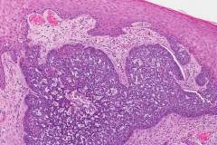 Nodular basal cell carcinoma of the skin