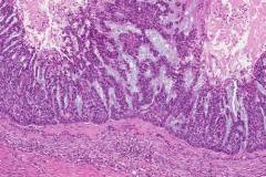 Nodular basal cell carcinoma of the skin