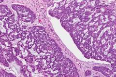 Nodular basal cell carcinoma of the skin