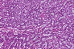 Nodular basal cell carcinoma of the skin