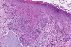 Nodular basal cell carcinoma of the skin