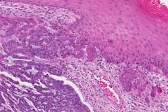 Nodular basal cell carcinoma of the skin