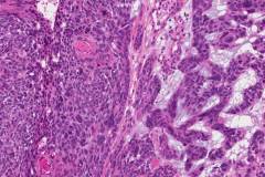Nodular basal cell carcinoma of the skin